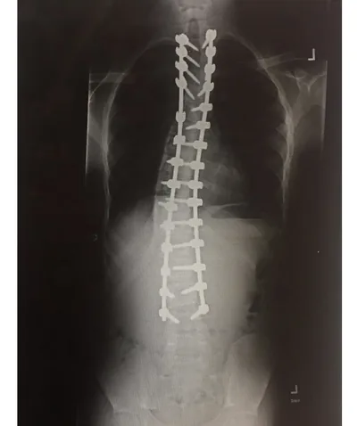 Rahsaan's spine X-ray after surgery