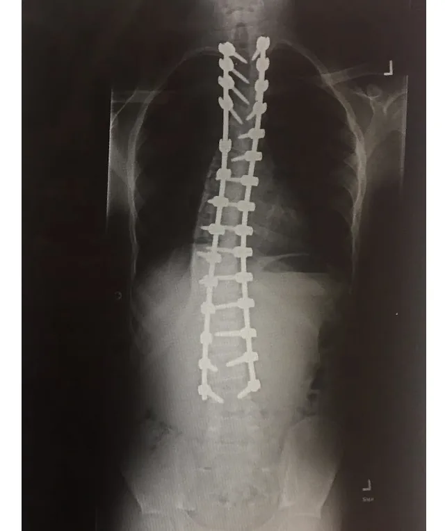 X-ray of Rahsaan's spine after surgery, straightened and held by rods and screws