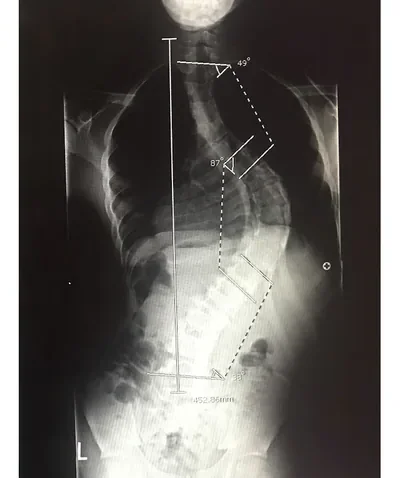 Rahsaan's spine X-ray before surgery