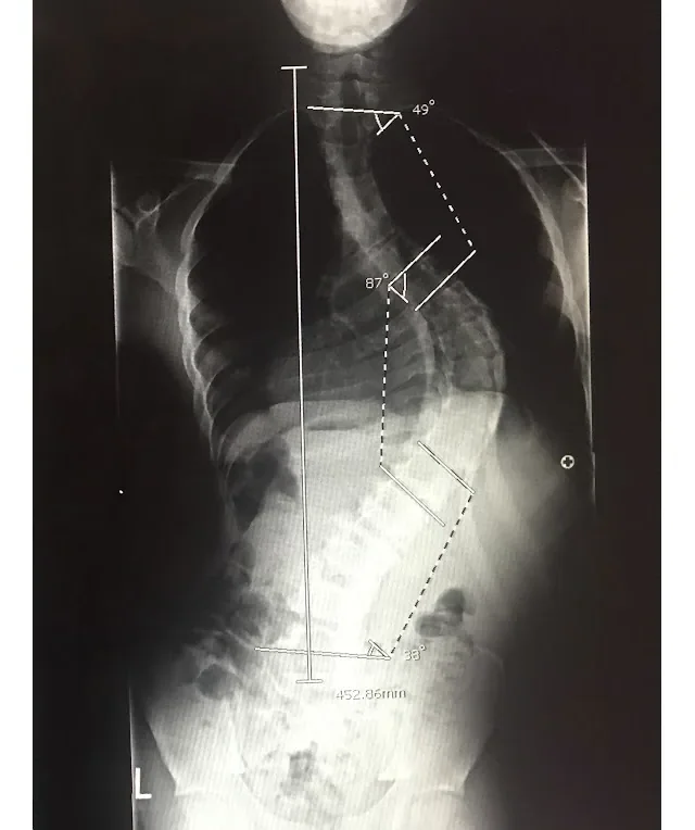 X-ray of Rahsaan's spine before surgery, showing a severe curve
